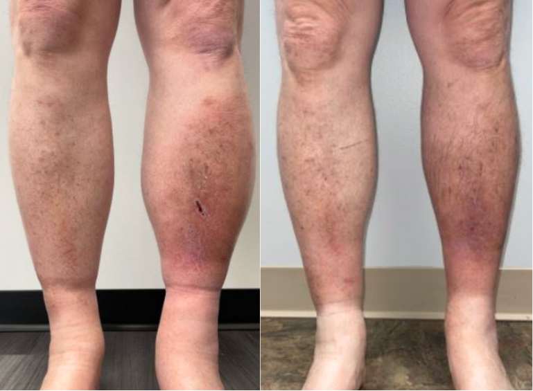 Leg Swelling and Ulcers AB1 and AB2 (1)