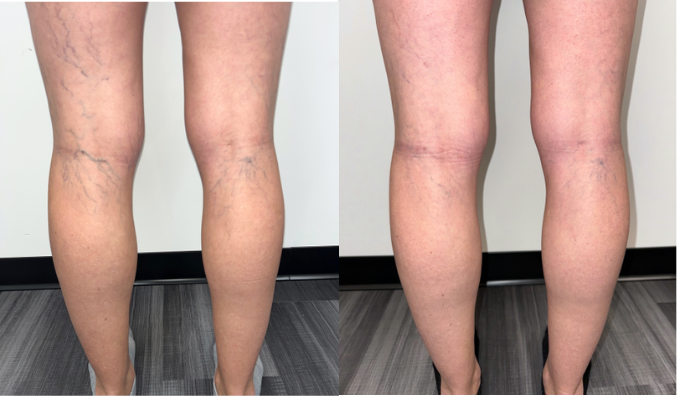 Spider Veins BH3 and BH4 (1)