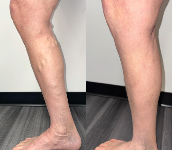 Varicose Veins SK1 and SK2 (1)